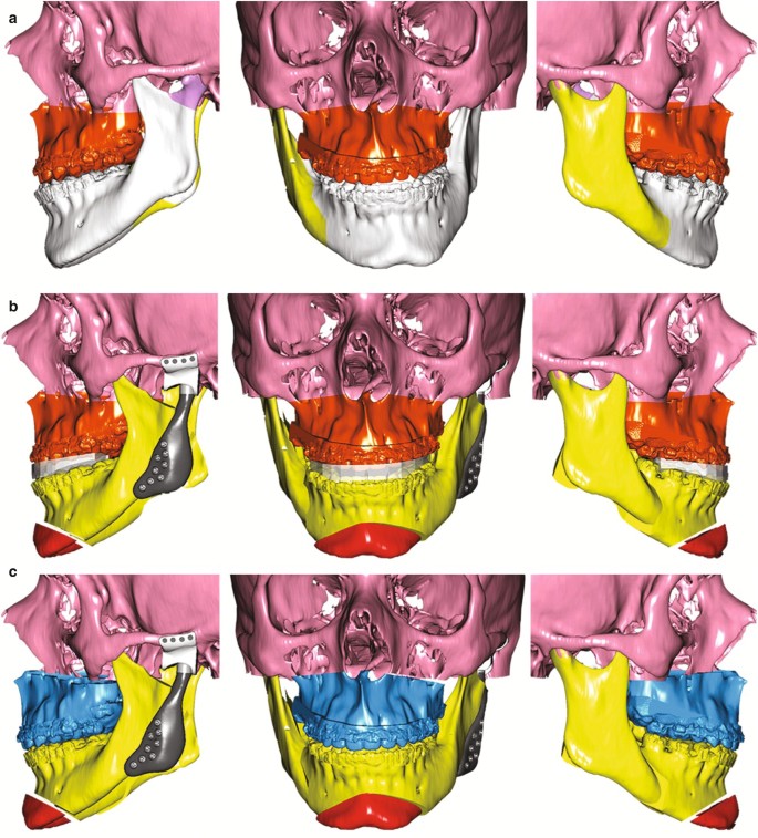 Clockwise versus counterclockwise rotation in bimaxillary surgery: 3D  analysis of facial soft tissue outcomes