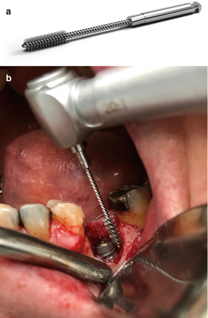 Removal of dental implants: review of five different techniques