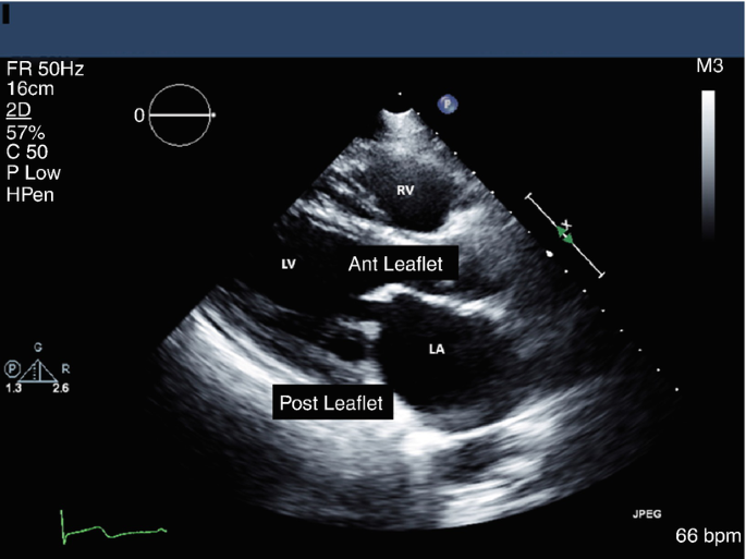 Mitral Valve | SpringerLink