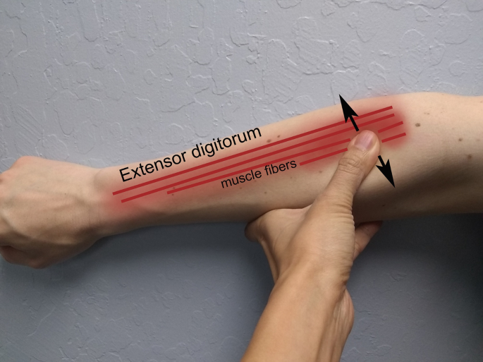 Example Myofascial Pain Case: Quadratus Lumborum Trigger Point and Chronic  Low Back Pain | SpringerLink