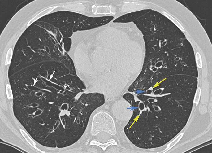 European Respiratory Society - Did you give the correct answer to this  week's radiology image challenge? See for yourself... B. Bronchiectasis.  There are thickened and dilated airways within the left lower zone