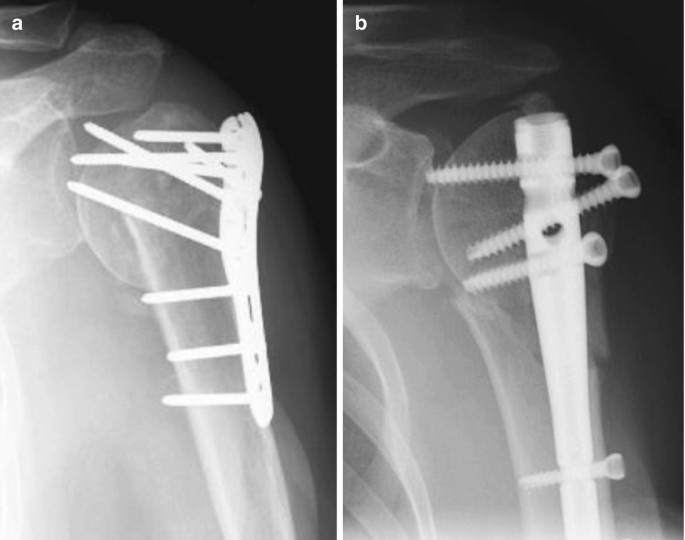 Proximal Humeral Fractures: The Choice of Treatment | SpringerLink