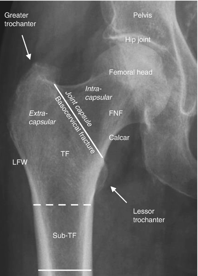 proximal femur fracture