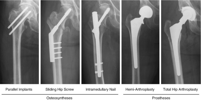 Hip Fracture: The Choice of Surgery | SpringerLink