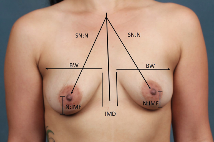 Measuring the breast base width while pinching the skin to