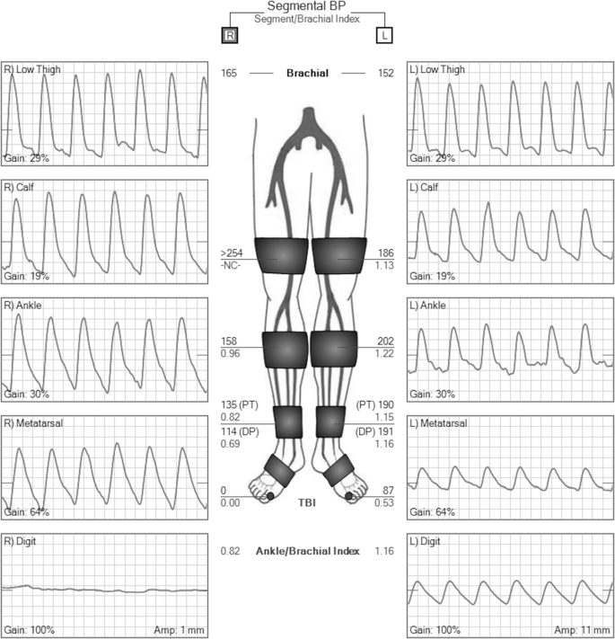 Pulse Volume Recording in the Diagnosis of Peripheral Vascular 