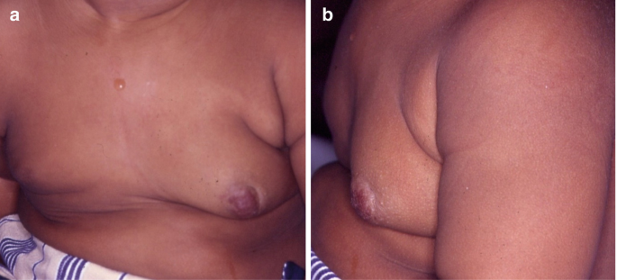 Breast development in pediatric patients from birth to puberty: physiology,  pathology and imaging correlation