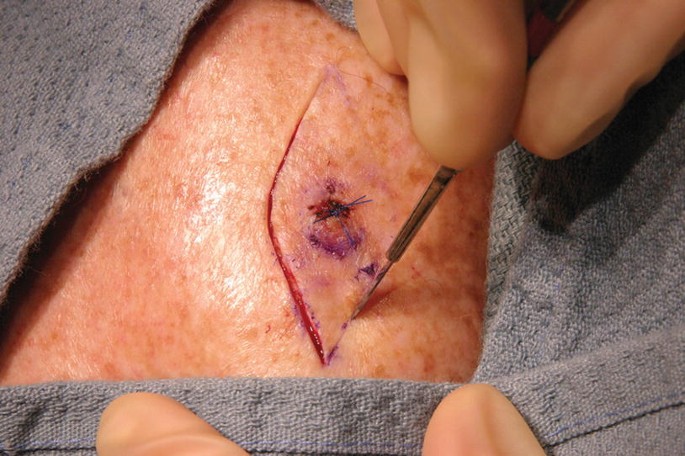 Dermatologic Complications of Dermabond after Orthopaedic Surgery