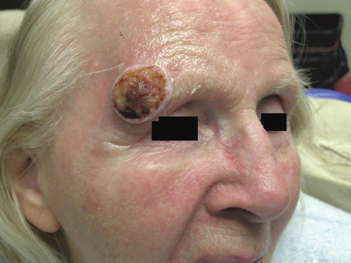 Diffuse Melanosis Cutis