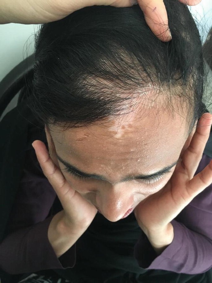 A 23-Year-Old Girl with White Hair from Birth | SpringerLink A 23-Year-Old Girl with White Hair from Birth | SpringerLink