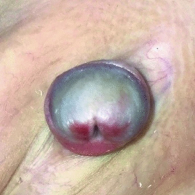Phimosis and ischaemia of the glans penis, both clinical signs of