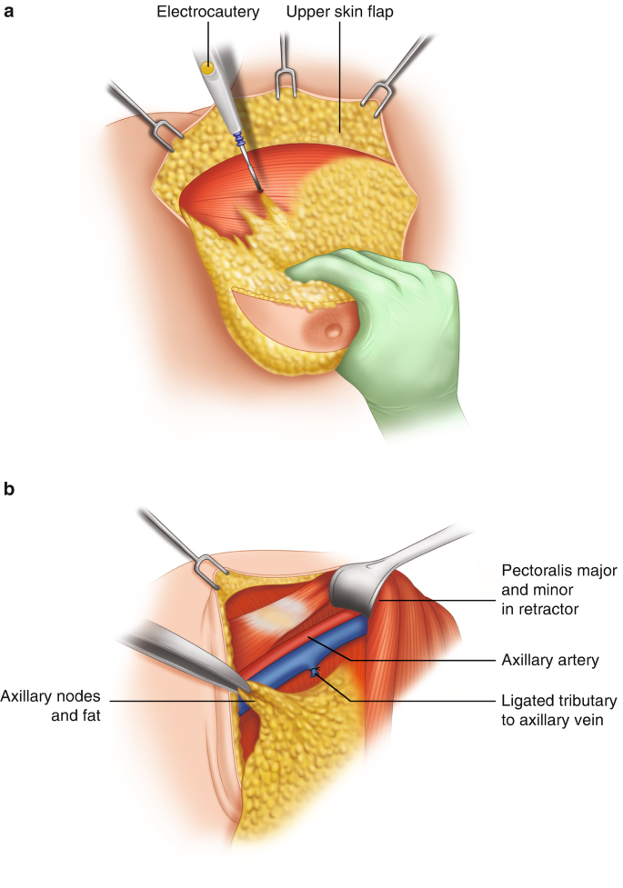 Nursing_knowledge - The breast is the tissue overlying the chest