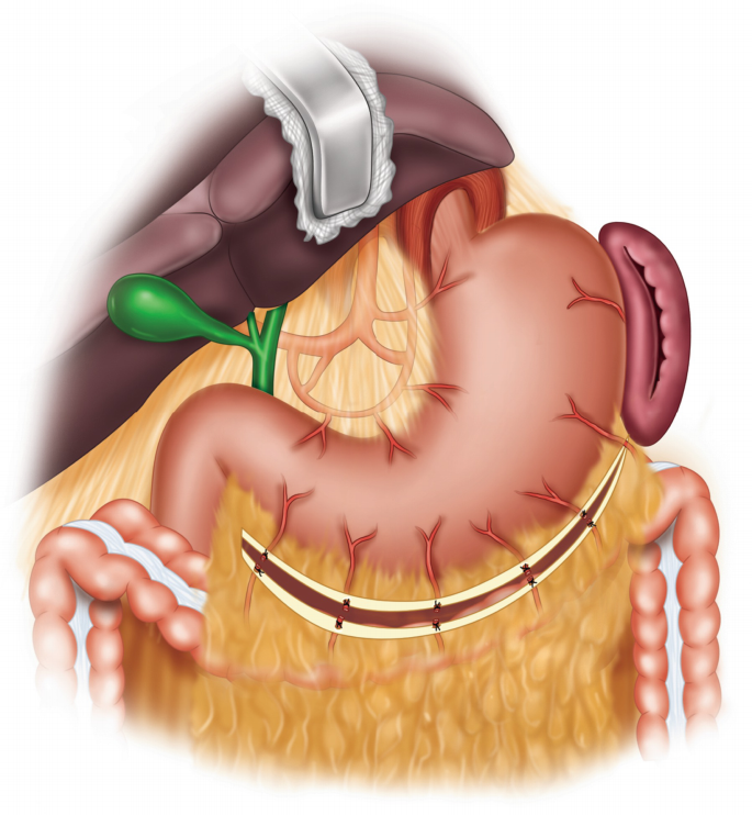 Port placement for gastric mobilization -SAGES Image Library