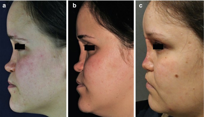 Surgical Treatment of Atrophic Rhinitis: The Use of Autografts in Nasal  Dorsum Repair | SpringerLink