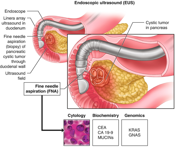 Cytopathological characteristics of solitary fibrous tumour involving the  pancreas by fine needle aspiration: Making an accurate preoperative  diagnosis in an uncommon location - Jones - 2022 - Cytopathology - Wiley  Online Library