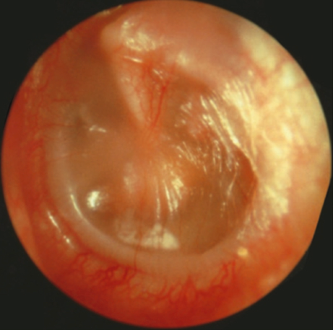 Otitis Media with Effusion (OME) | SpringerLink