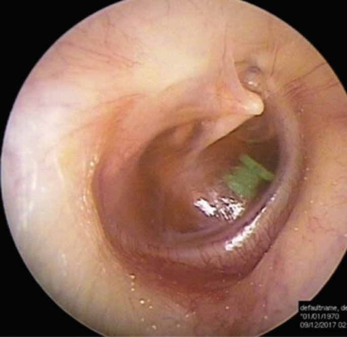 Ventilation tubes (grommets) for otitis media with effusion (OME