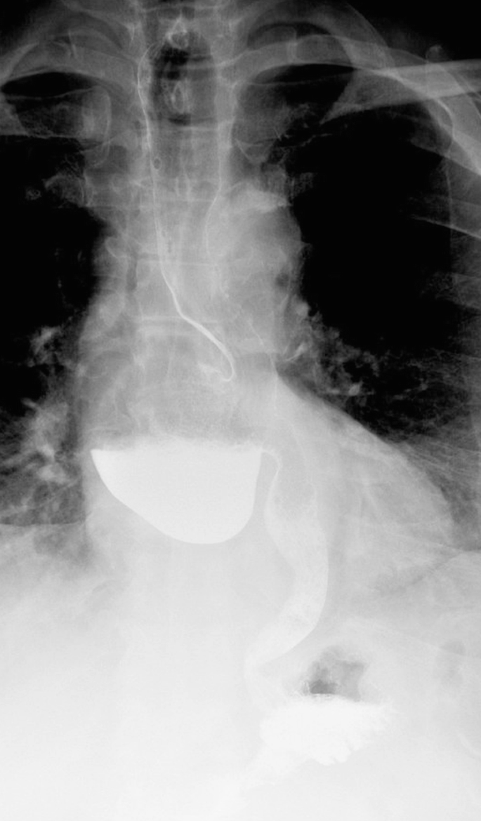 SciELO - Brasil - TREATING SIMPLE BENIGN ESOPHAGEAL STRICTURES WITH  SAVARY-GILLIARD DILATORS: IS THE RULE OF THREE STILL NECESSARY? TREATING  SIMPLE BENIGN ESOPHAGEAL STRICTURES WITH SAVARY-GILLIARD DILATORS: IS THE  RULE OF THREE