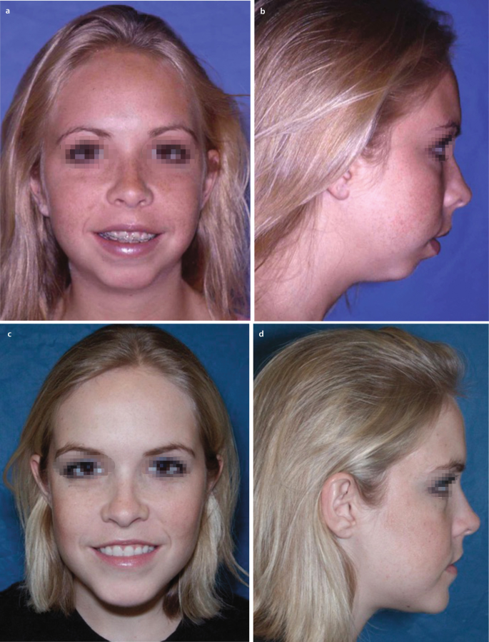 Counterclockwise Face Rotation - Corrective Jaw Surgery - Dr. Antipov