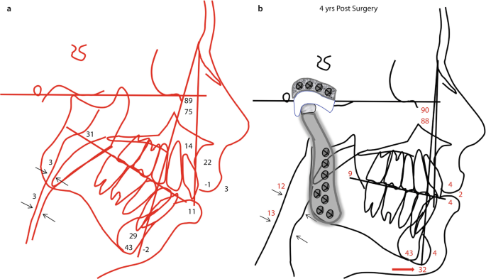 Counterclockwise Rotation of the Maxillomandibular Complex for the