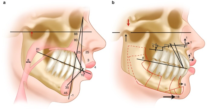 Counterclockwise Rotation of the Maxillomandibular Complex for the