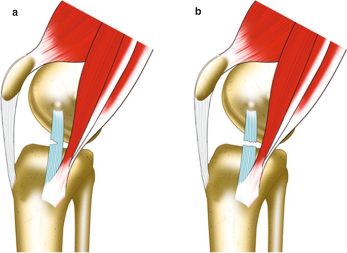 Medial Collateral Ligament Knee Instability