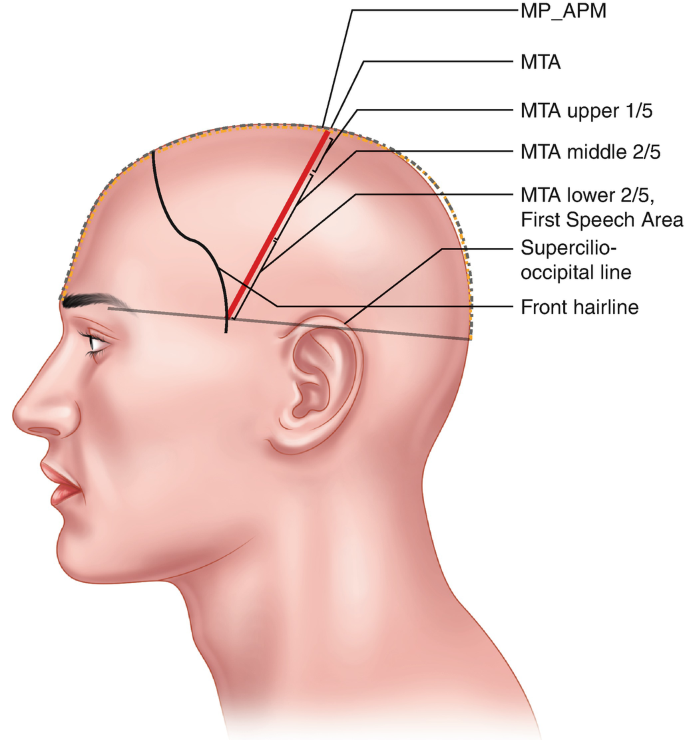 Scalp Acupuncture Springerlink