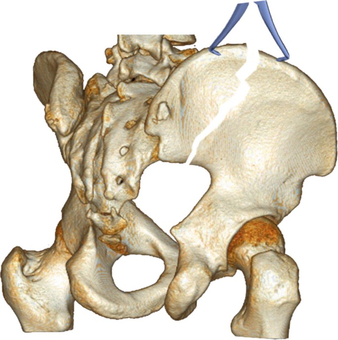 Posterior Approach To The Iliac Crest