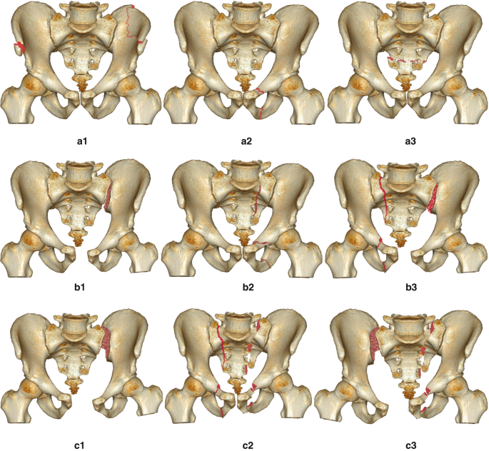 Minimally invasive plate osteosynthesis on anterior pelvic ring injury and  anterior column acetabular fracture. | Semantic Scholar