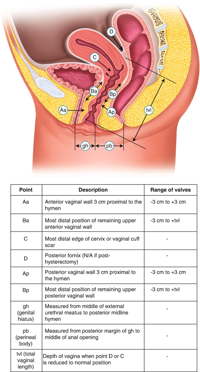 What Are the Treatment Options for Pelvic Organ Prolapse? - StoryMD, image size:685x1270