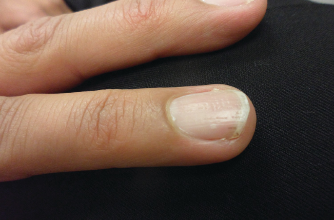 My nail cracked in the middle. What should I do? - Quora
