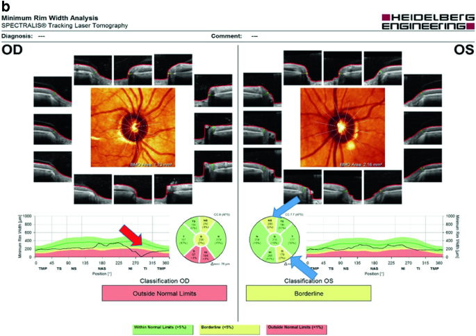 OCT and Glaucoma: Case Review | SpringerLink