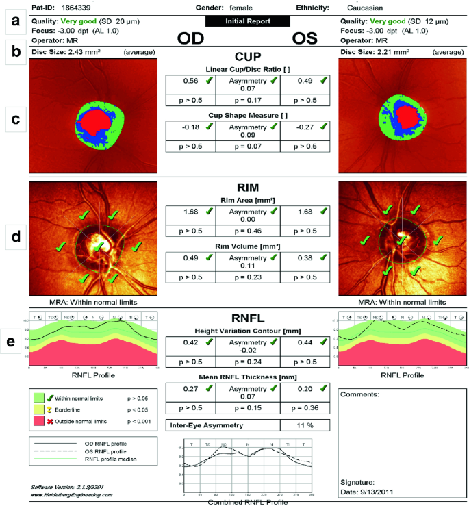 Confocal Scanning Laser Ophthalmoscopy and Glaucoma | SpringerLink
