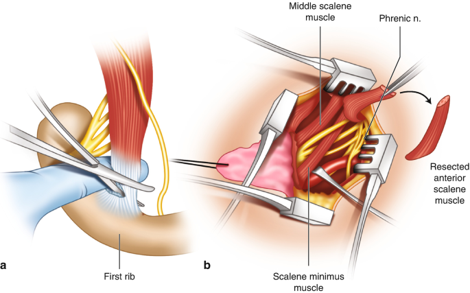 Surgical Techniques: Operative Decompression Using the Supraclavicular  Approach for Neurogenic Thoracic Outlet Syndrome | SpringerLink
