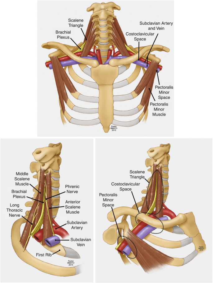 Diagnosis of Neurogenic Thoracic Outlet Syndrome: 2016 Consensus