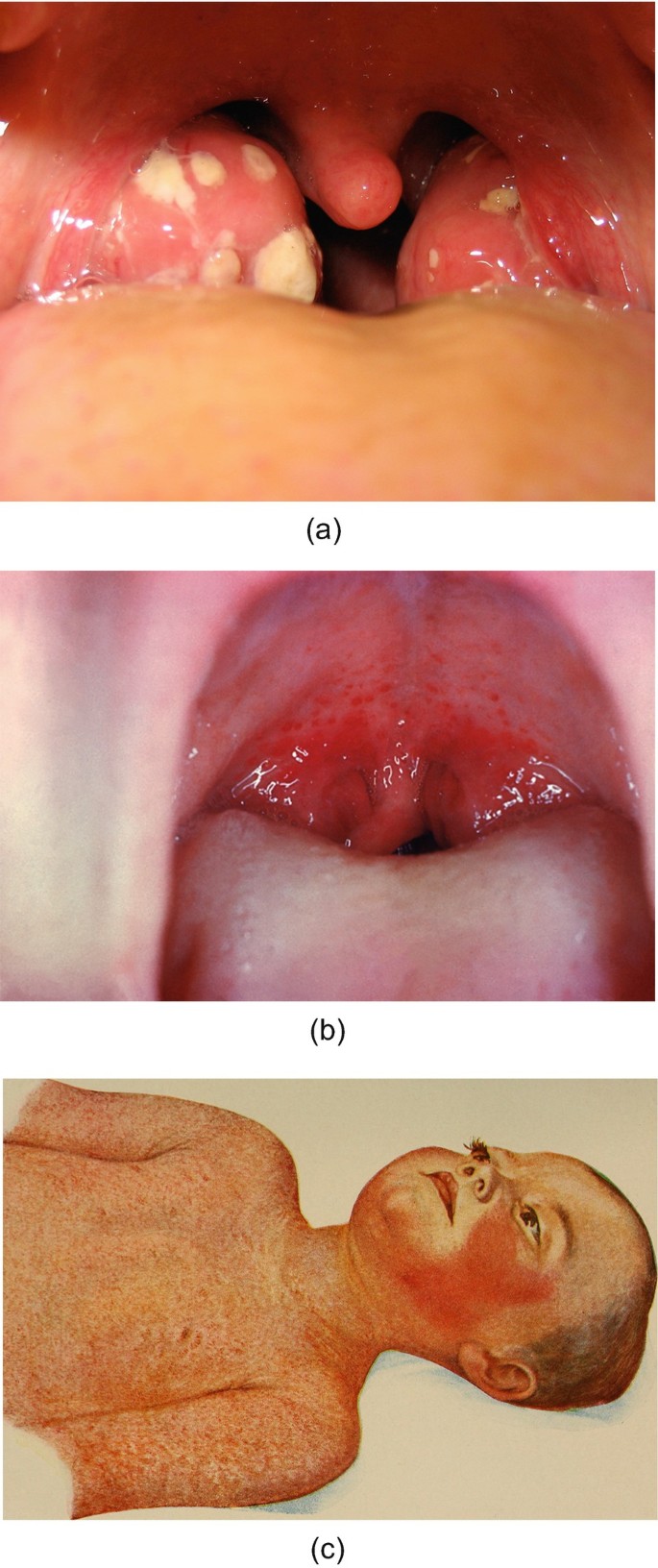 Scarlet fever - Symptoms & causes - Mayo Clinic