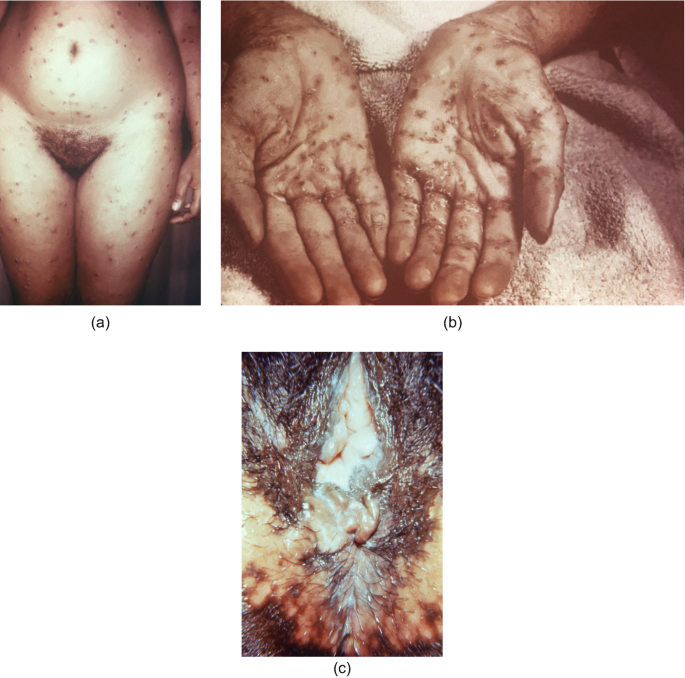 Syphilis | SpringerLink