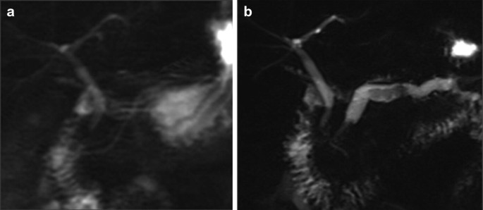 obesity effect in glp-1 agonist kinetics Dose dependent effects of the GLP-1 RA liraglutide on body weight in
