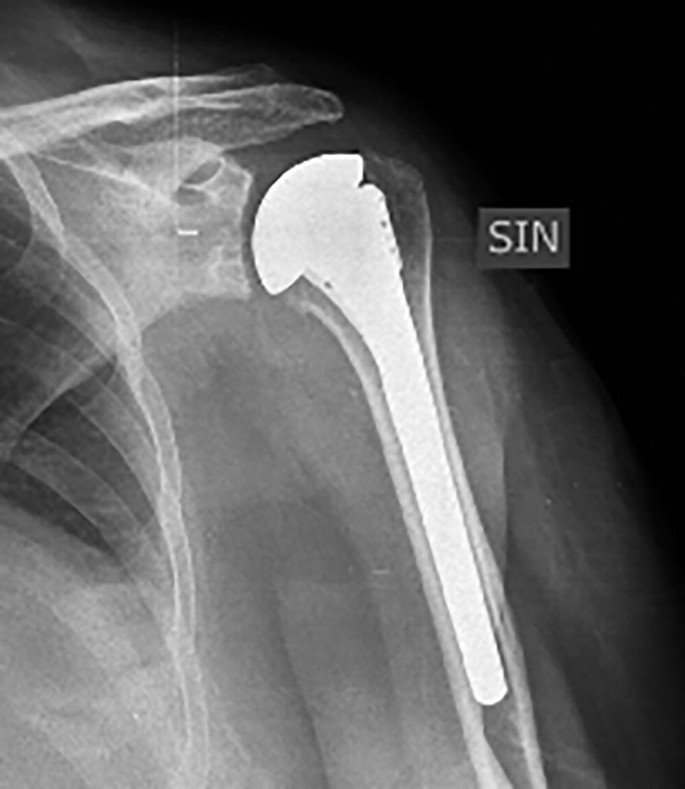 Postoperative Imaging of the Shoulder | SpringerLink