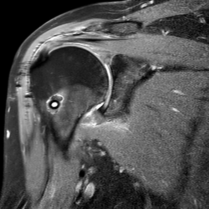 Postoperative Imaging of the Shoulder | SpringerLink