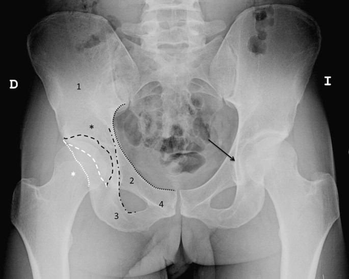 Normal Pelvis and Hip | Springer Nature Link
