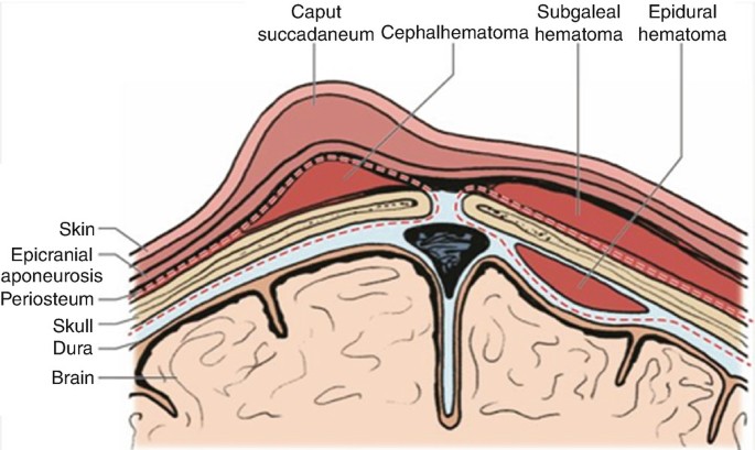 Caput Succedaneum and Molding: Ultrasound and Digital Correlations |  SpringerLink