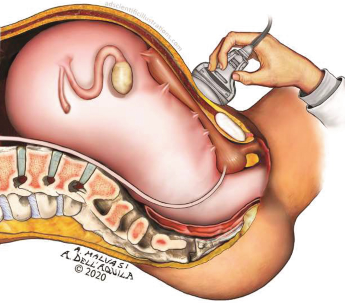 Traditional and Sonographic Anatomy of the Pregnant Uterus | SpringerLink