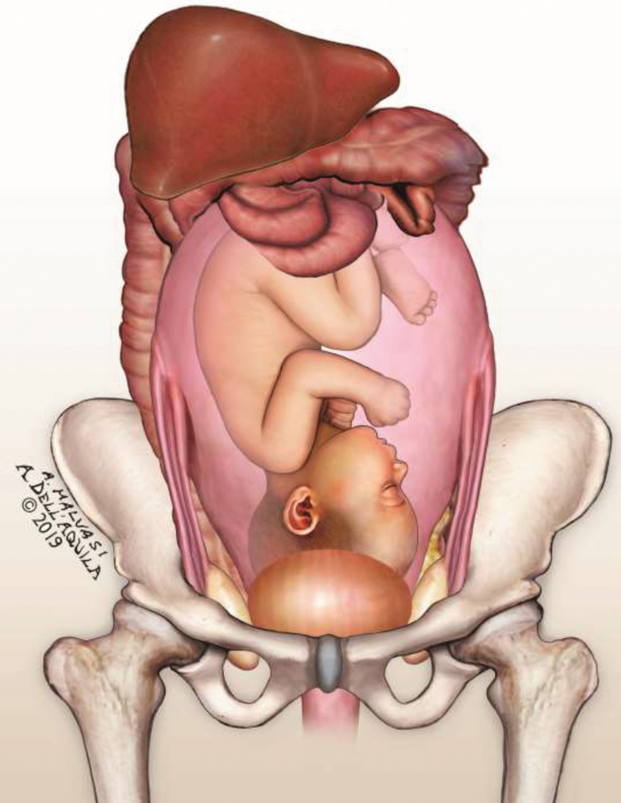 Traditional and Sonographic Anatomy of the Pregnant Uterus