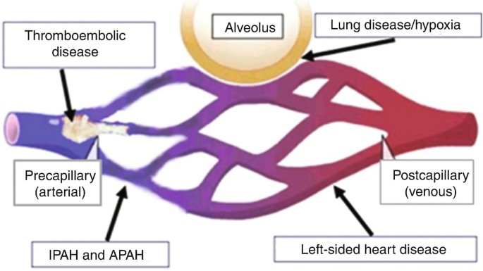 Pulmonary Hypertension In Obstructive Sleep Apnea | Springerlink