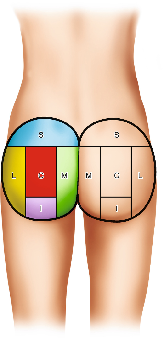 Gluteal Aesthetic Unit Classification