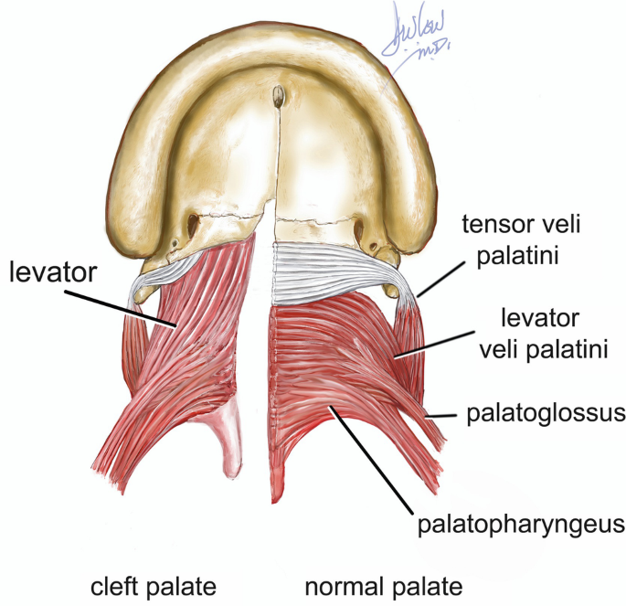 Patterns, Anatomy, and Classification of Clefts | SpringerLink