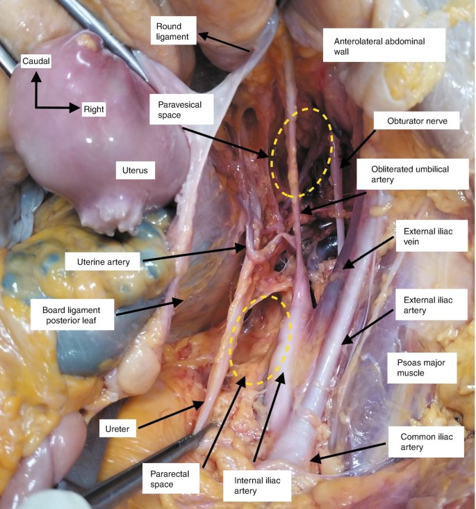 Cervix　Dissection Laparoendoscopic Single-Site Surgery With Hysterectomy in Patients With  Prior Cesarean Section: Comparison of Surgical Outcomes With Bladder  Dissection Techniques - Journal of Minimally Invasive Gynecology
