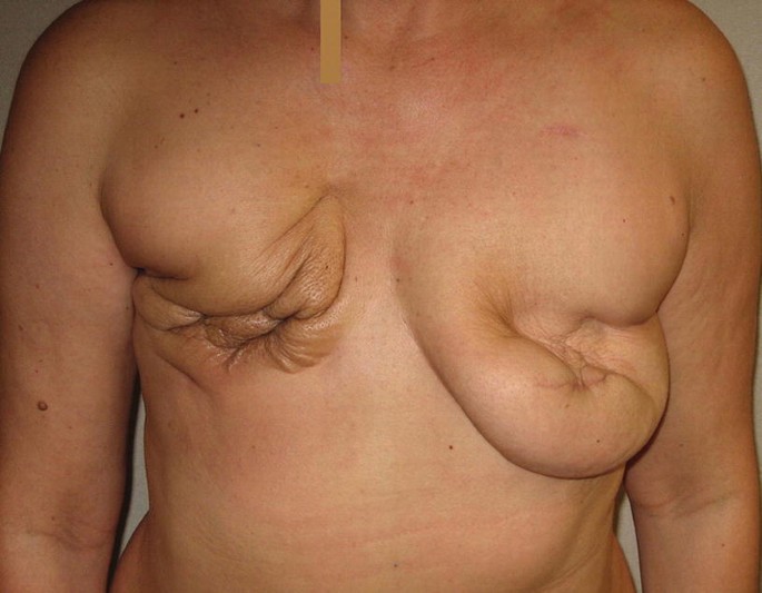 Shaping the Breast: Optimizing Aesthetics with Reconstructive