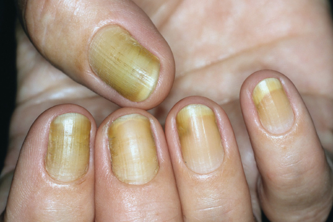 Yellow Nail Syndrome-Nails-Signs of Diseases-Healthy-Best Homeopathic Doctor-Dr Qaisar Ahmed-Al-Haytham Clinic-Risalpur-KPK-Pakistan